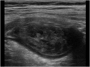 Longitudinal high resolution image of the appendix showing an intraluminal 
