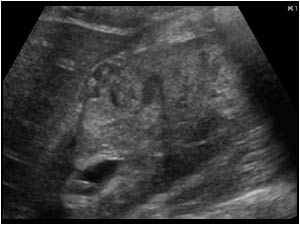 Longitudinal image of the right kidney with an ill defined iso and hypoechoic mass in the kidney