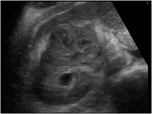 Transverse image of the right kidney. The mass is inhomogeneous with small cystic areas.