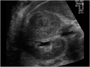 Transverse image of the right kidney the mass has a target like appearance with a central hypoechoic area.