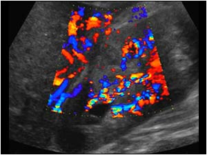 Longitudinal image of the right kidney with color Doppler. There is a wedge shaped area without vascularity and a central hypoechoic area.