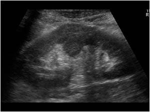Longitudinal image of the normal left kidney