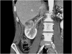 CT scan of the same lesion in the right kidney