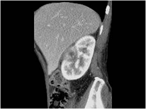 CT scan of the same lesion in the right kidney.