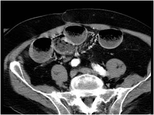 Dilatated small bowel loops