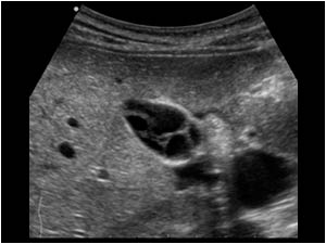 Case of the month October 2009: Miscellaneous gallbladder