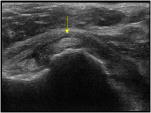 Luxation of the biceps tendon and absent subscapularis transverse