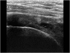 Supraspinatus tendon rupture and bursa with synovial proliferations longitudinal