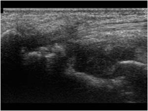 Synovial thickening at the flexor carpi radialis tendon insertion longitudinal