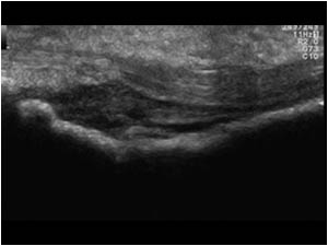 Soft tissue mass under the flexor tendon longitudinal