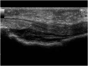 Soft tissue mass under the flexor tendon longitudinal