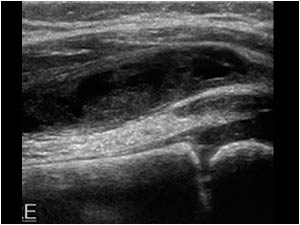 Effusion and thickened synovium in the anterior recess longitudinal