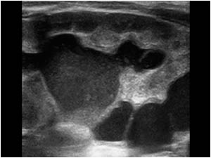 Dilatated right kidney and ureter longitudinal