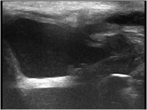 Dilatated proximal urethra longitudinal