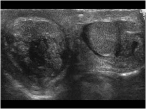 Swollen necrotic and normal testis transverse