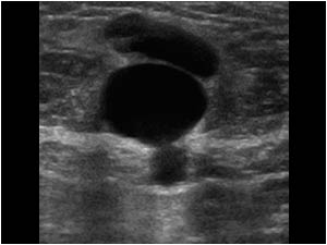 Transverse image of the lesion in patient 1