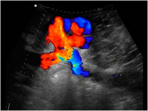 Longitudinal color Doppler image of the lesion of patient 2. There is flow and there is a vessel entering and leaving the lesion.
