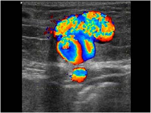 Transverse color Doppler image of the lesion of patient 1 also showing flow.
Both lesions represent a herniating paraumbilical vein varix.
Did you notice the vessel directly underneath the abdominal wall?