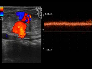 The Doppler spectrum confirms the venous nature of the lesion in patient 1.