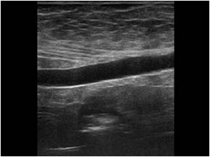 Longitudinal image of the vein underneath the abdominal wall of patient 1. Can you guess where the vein is coming from?