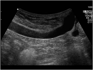 Longitudinal image of the upper abdomen of patient 2. There is also a vein running underneath the abdominal wall.