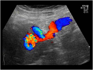 Longitudinal color Doppler image of patient 2. The vein can be followed all the way to the liver.