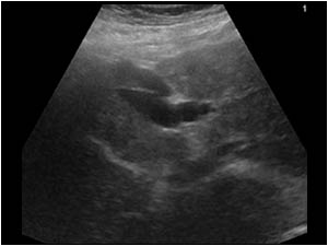 Transverse image of patient 2 showing the vein in relation to the liver.
In both patients the venous structure in the upper abdomen represents a recanalized umbilical vein or a widened paraumbilical vein.
A recanalized umbilical or a widened paraumbilic