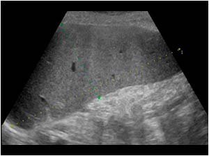 Anechoic structure in the abdominal wall in the umbilical region