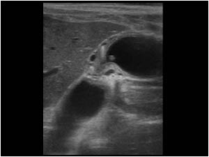 Longitudinal image of the gallbladder with an abnormally thickened wall especially in the central part of the gallbladder. The cranial part of the gallbladder is relatively normal. There are multiple small diverticula in the thickened part of the gallblad