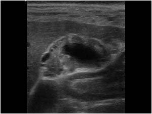 Transverse image of the gallbladder fundus showing a thickened wall with small diverticula and hyperechoic foci.