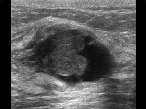 Intracystic lobulated mass in an ill defined cyst with an irregular wall