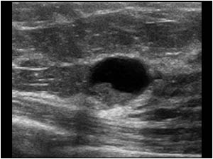Sometimes the lesion looks less suspicious as in this case of a complex cyst in the breast of a 73 year old female patient. There is a thin walled cyst with a mural nodule that did not move when the patient changed position. Although no vascularity was fo