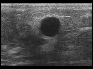 When dealing with breast cysts, optimal settings are very important. This less than 1 cm. breast lesion was found in a 67 year old female patient and initially interpreted as a simple benign cyst.