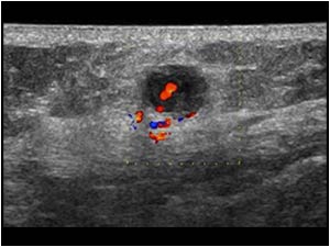 The color Doppler proves the lesion to be vascularized