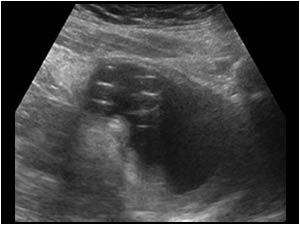Longitudinal image of the bladder with an unusual structure in the fundus of the bladder.