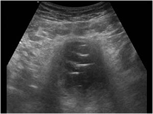 Transverse image of the same structure in the bladder.