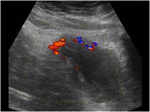 There is an increased vascularity in the bladder wall indicating a cystitis.
Because the kidneys are always included in the ultrasound examination of the urinary tract we also examined the kidneys.