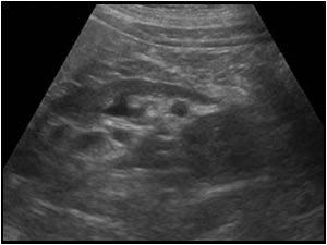 Longitudinal image of the right kidney with a hypoechoic mass in the lowerpole of the kidney.