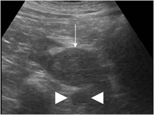 Transverse image of the mass in the lowerpole of the right kidney (thin arrow).
Also notice the position of the mass in relation to the aorta (arrow points).