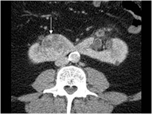 CT scan of the lowerpole of the kidneys. There is a horseshoe kidney. The mass in the lowerpole of the right kidney is clearly seen and is located anterior of the aorta.