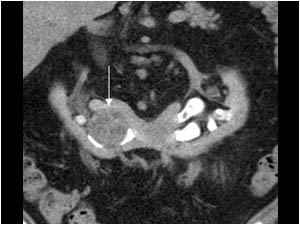 Coronal CT image in the late phase, showing again the horseshoe kidney and the tumor.