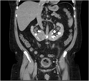 In the lower abdomen the abnormal bladder can be seen. The intraluminal structure has a low density on CT.