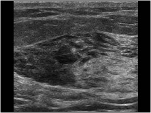 Ultrasound image of the palpable mass