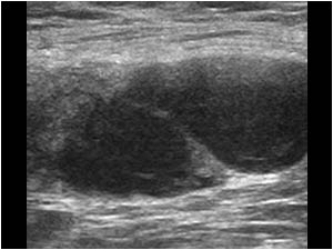 Ultrasound image of the palpable axillary lymph node