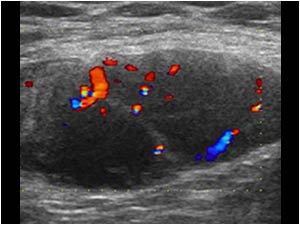 Color Doppler image of the palpable lymph node