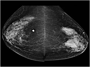 The mammography shows a marked asymmetry on the cranio-caudal view