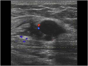 Color Doppler shows one vessel pole
When a painful mass is found in the abdominal wall of a young female patient, it is important to check if the patient has had a previous cesarean delivery or other gynaecological operation. In this case the mass was lo
