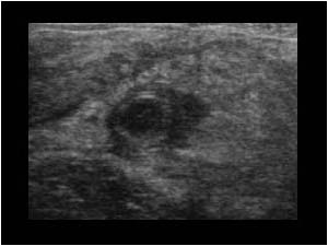 Inflamed mesoappendix transverse