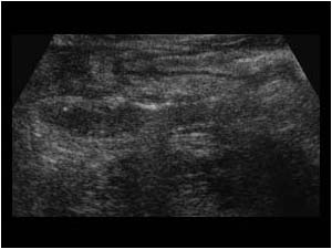 Thickened turned up retrocecal appendix longitudinal