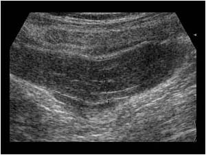 Thickened appendix in a patient with NHL longitudinal